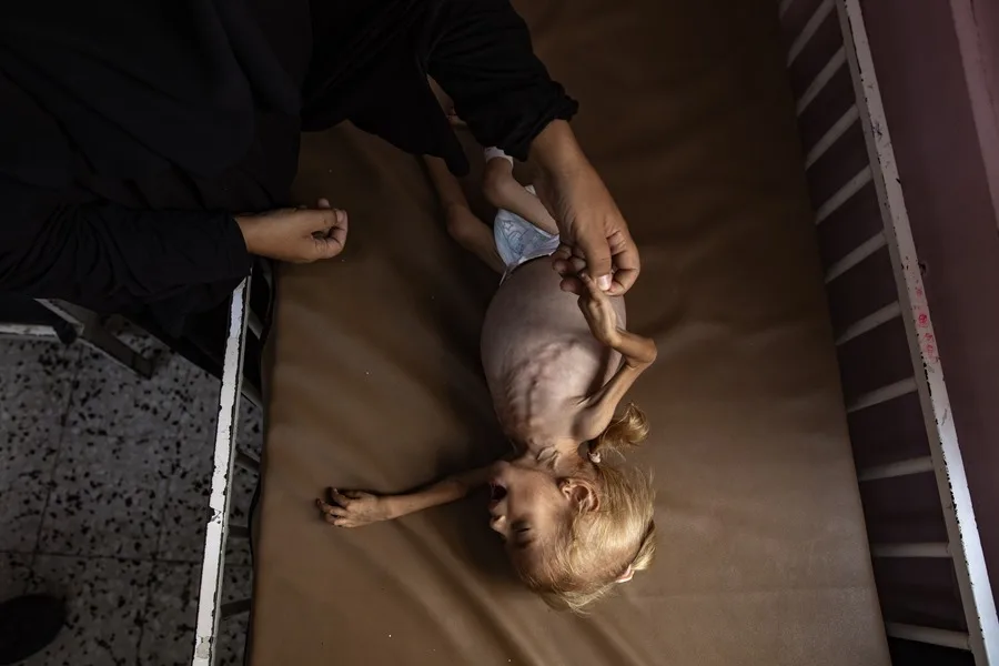 Desnutrición en Gaza: muertes alarmantes en 2023