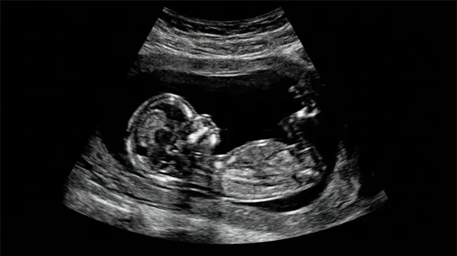 Aborto y derechos en Puerto Rico