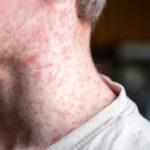 Nueva York declara emergencia por sarampión ante aumento de casos y propagación en zonas rurales